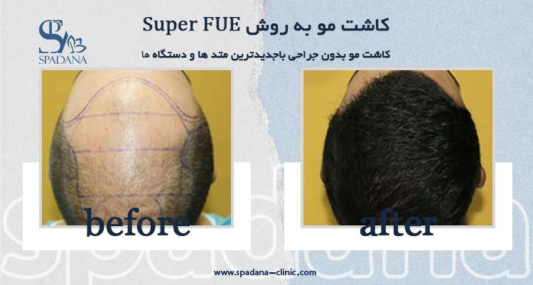 کاشت مو به روش Super FUE